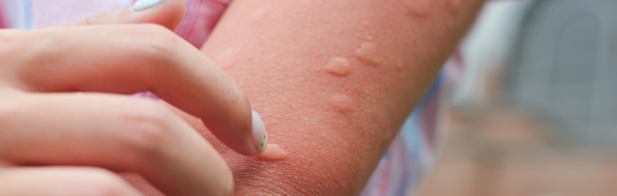 Typisches Anzeichen einer Mückenstich-Allergie: Quaddeln am Arm einer Patientin.