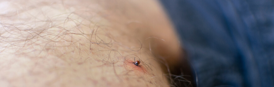 Bein eines Mannes, auf dem sich eine Zecke in der Haut verhakt hat und dadurch eine Zeckenkrankheit verursachen könnte.
